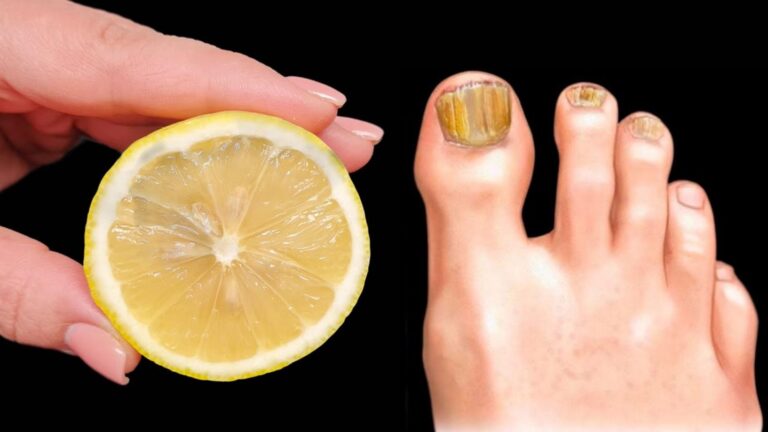 10 naturalnych sposobów na szybką walkę z grzybicą paznokci!