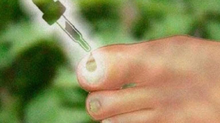 Pokonaj grzybicę stóp w 3 prostych krokach – odkryj skuteczne sposoby!